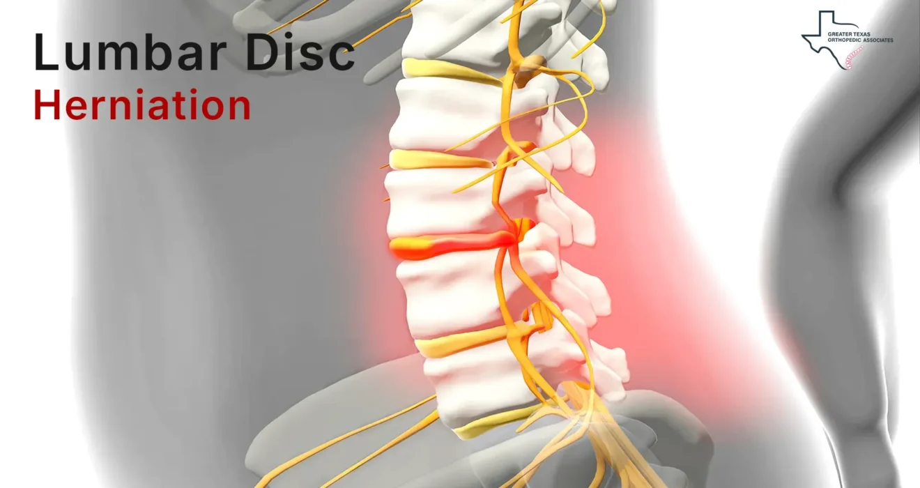 herniated lumbar disc