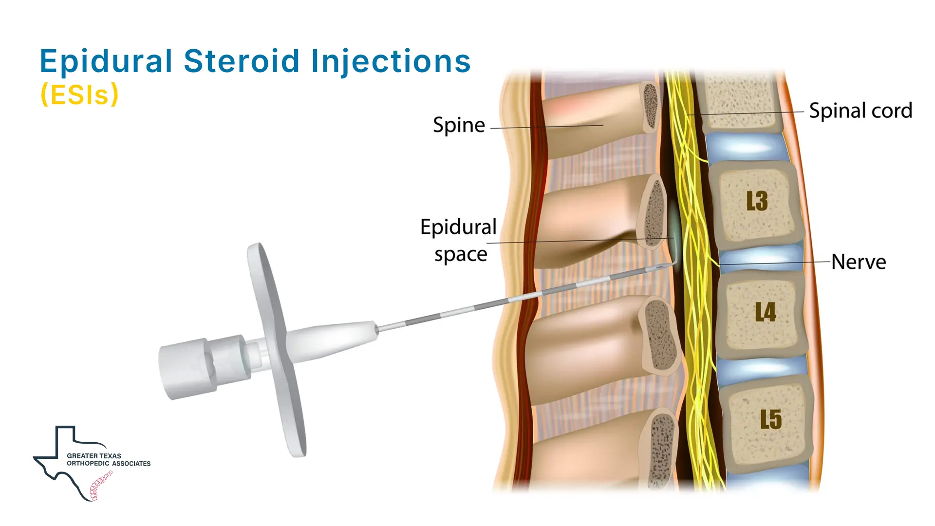 Non-Surgical Treatment for Lumbar Herniated Disc