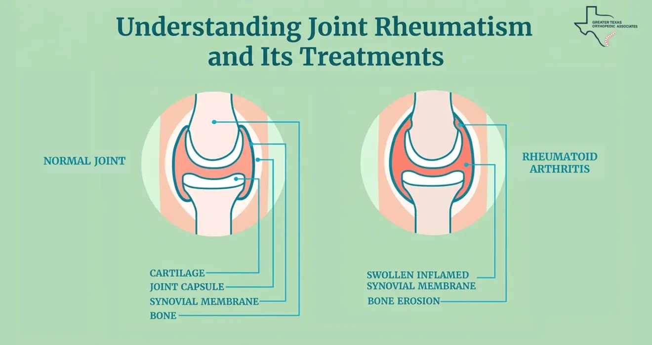 Understanding Joint Rheumatism and Its Treatments