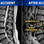 Aggravation of a Pre-Existing Injury After a Car Accident