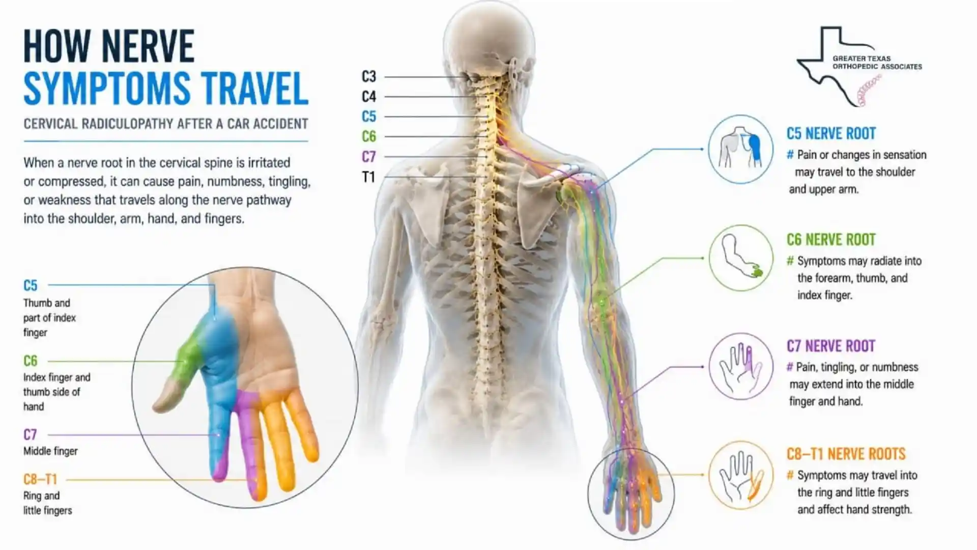 Cervical radiculopathy nerve symptoms traveling from the neck into the shoulder, arm, hand, and fingers